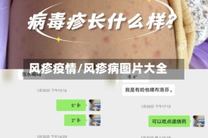 风疹疫情/风疹病图片大全