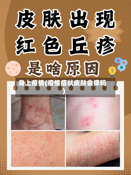 身上疫情(疫情症状皮肤会痒吗)-第1张图片